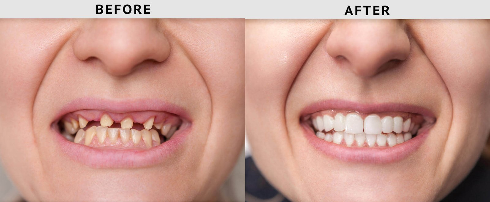 Best veneers teeth in Surat